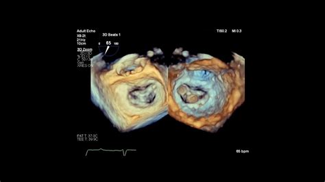 Mitral Valve Transcatheter Edge To Edge Repair Youtube