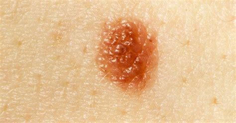 Is This Mole Dangerous The Truth About Detecting Skin Cancer