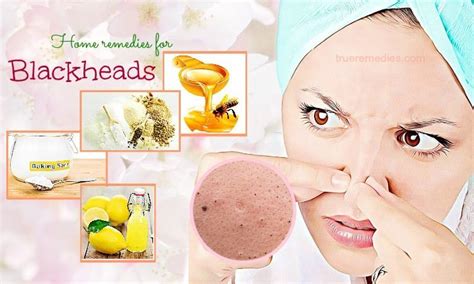 34 Home Remedies For Blackheads On Nose And Face Removal