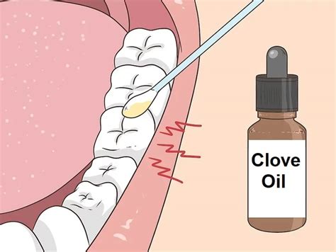 Can I Use Clove Oil To Relieve Toothache News Dentagama