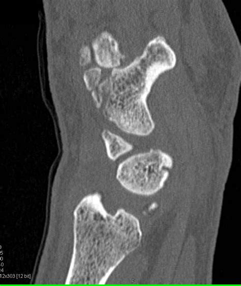 Multiple Carpal Bone Fractures Including Tibial Blood Flow