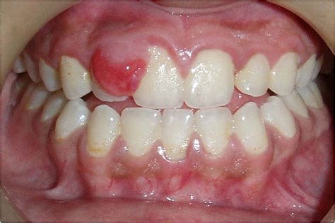 Peripheral Ossifying Fibroma A Clincal Report June 2011 Compendium
