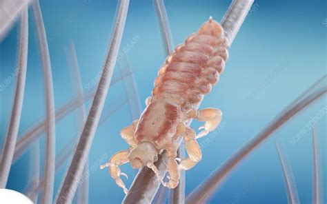 Head Louse On A Human Head Illustration Stock Image F0291153