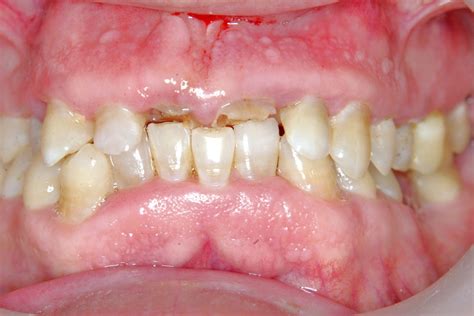 ¿por Qué Tengo Desgaste Dental Dentisalut