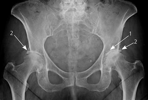 Degenerative Joint Disease Of The Hip Osteoarthritis Of The Hip My