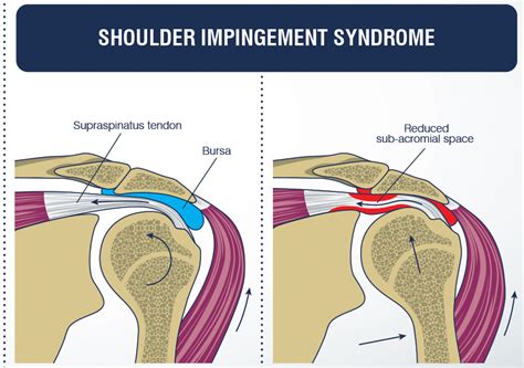What To Do When You Feel Anterior Shoulder Pain What Is Subacromial
