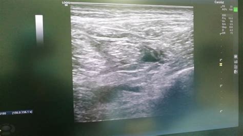 Ultrasound Guided Popliteal Sciatic Nerve Block Youtube