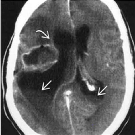 Abnormal Mri Brain Ependymitis Radiology Imaging