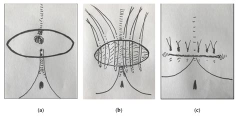 Pilonidal Cyst Diagram