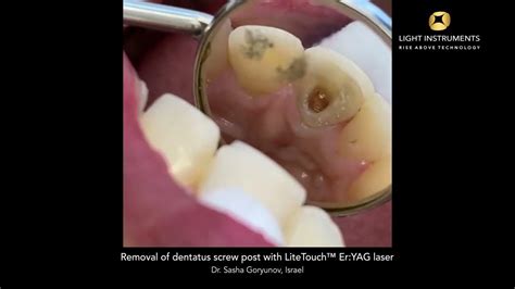 Removal Of Dentatus Screw Post With Litetouch™ Eryag Laser Youtube