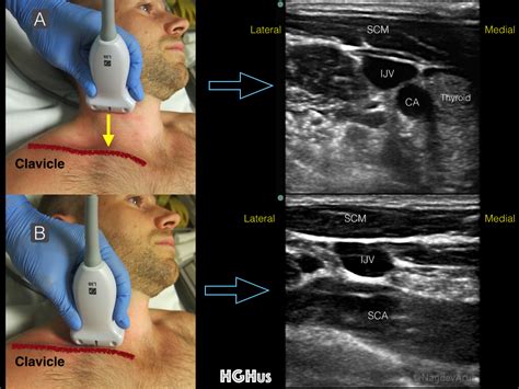 Supraclavicular Subclavian — Highland Em Ultrasound Fueled Pain Management