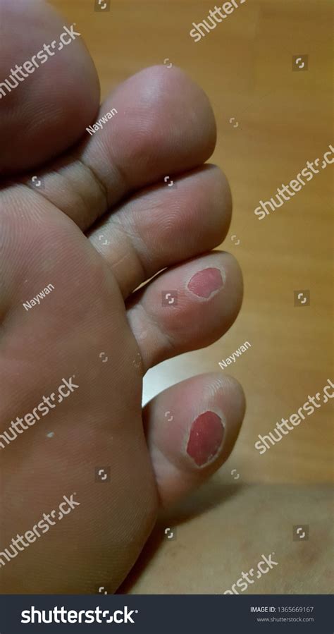 Big Bloody Callus On Mans Foot Stock Photo 1365669167 Shutterstock