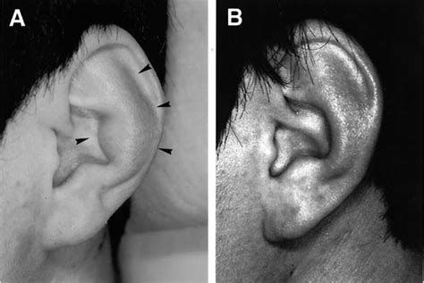 Treatment Of Recurrent Auricle Pseudocyst With Intralesional Injection