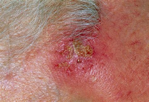 Solar Keratosis Skin Disorder Stock Image M1900046 Science Photo