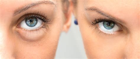 Tear Trough Fillers For Bags Under Eyes West Institute Chevy Chase