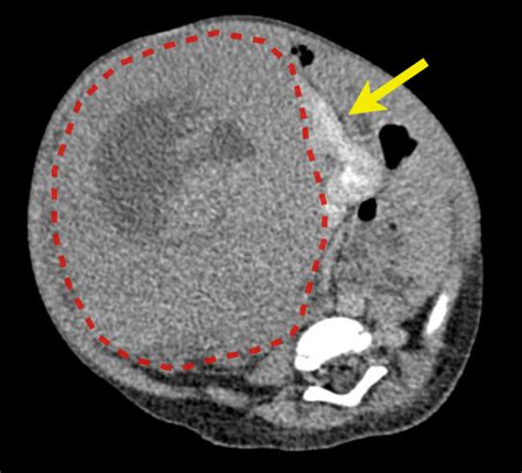 Wilms Tumour Claw Sign Radiology Case Large