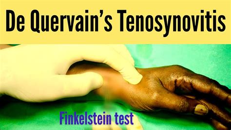 De Quervains Tenosynovitis Live Surgery 1st Extensor Compartment