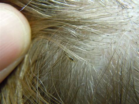 As with all topical products, hair dye will not penetrate the casing of the nits and therefore they might be a different color, but they will not be dead. What Do Lice Look Like, The Video Is Kinda Gross But Necessary