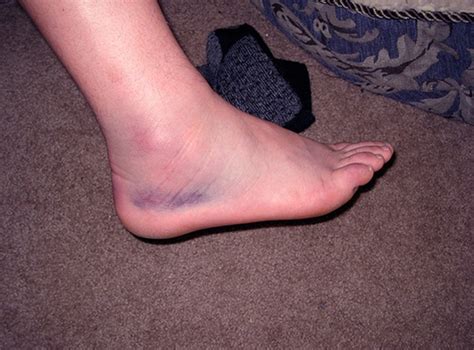 Swollen Ankles Treatment Pictures Pregnancy Symptoms Causes
