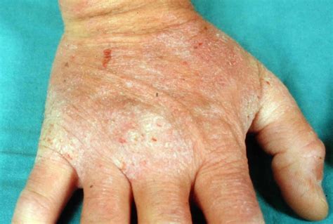 Mild Dermatitis Herpetiformis On Hands