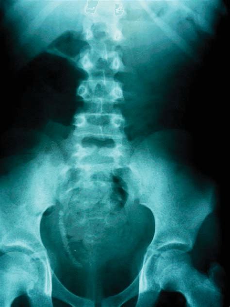 Plain X Ray Of The Urinary Tract Showing A Patient With Unilateral