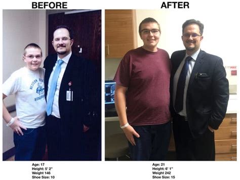 Mans Unusual Tumor Halted His Growth During Teen Years