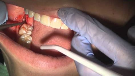 Are Wisdom Teeth Important Viral Rang