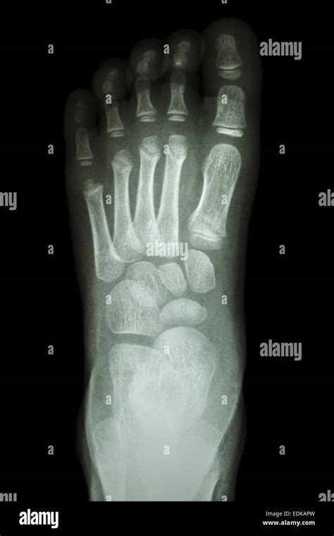 Film X Ray Foot Ap Show Normal Childs Foot Stock Photo 77257569 Alamy