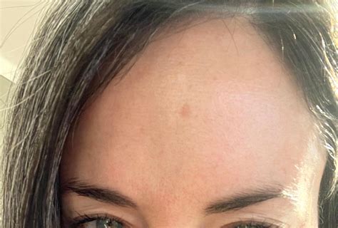 Very Slightly Raised Spot On Forehead Rdermatologyquestions