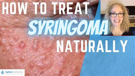 How To Treat Syringoma Natural Remedies And Medical Procedures