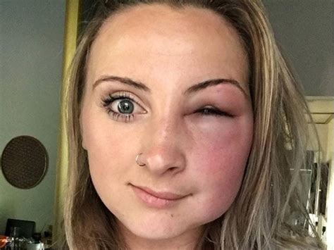 here s what happens if you get stung by a bee near your eye shropshire star