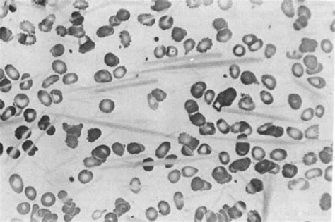 Cryoprotein Crystals Present In A Peripheral Blood Smear Crystals