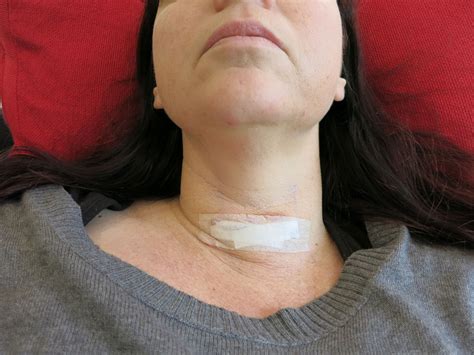 Thyroid Surgery One Year On Zinc Moon