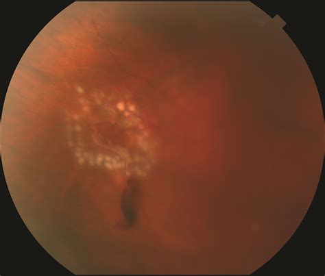 Retinal detachment is a sight threatening condition with an incidence of approximately 1 in 10000. Retinal Tears | Retina Specialists of North Alabama, LLC