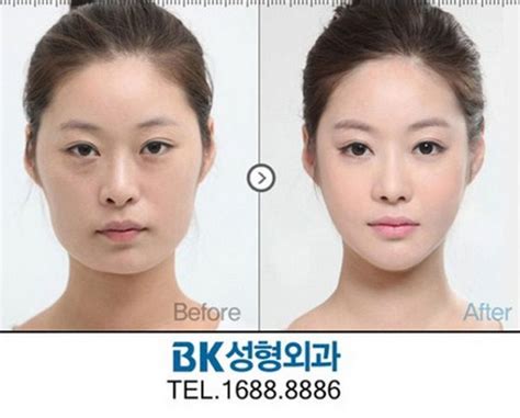 20 Almost Unrecognizable Plastic Surgery Before And Afters Korean
