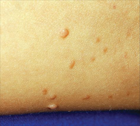 Multiple Brown Macules And Papules On A Female Teenager—quiz Case