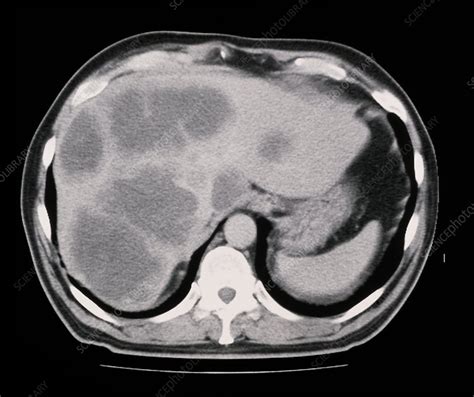 Ct Scan Showing Cancer Of The Liver Stock Image M1340245 Science