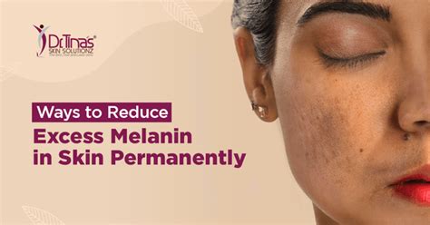 Ways To Reduce Excess Melanin In Skin Permanently Skin Solutionz