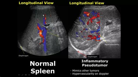 Spleen Ultrasound Normal Vs Abnormal Image Appearances Comparison