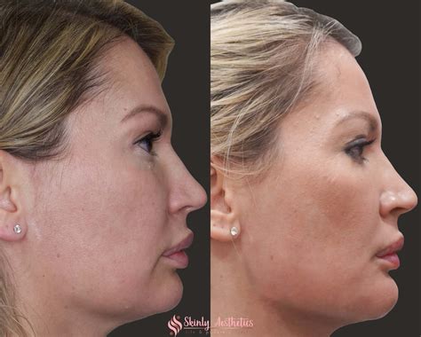 Jawline Fillers Before And After Results At Skinly