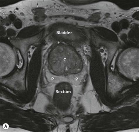 Prostate Radiology Key