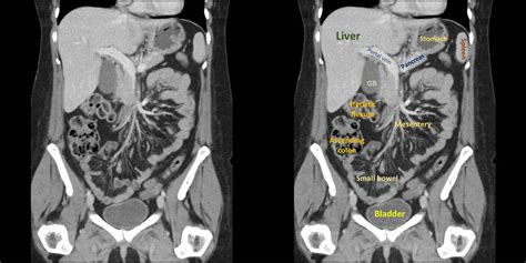 Abdominal X Ray Anatomy Anatomical Charts And Posters
