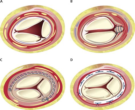 Diagnosis And Treatment Of Tricuspid Valve Disease Current And Future