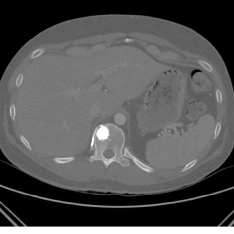 A Chest Ct Scan Performed After The Thoracotomy And Wedge Resection