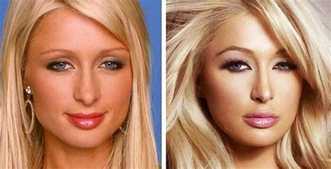 Celebrity Blepharoplasty Before And After 10 Celebrities That Have Had Eye Lift Surgery Yen