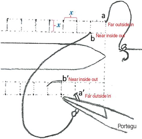 Pdf Modified Continuous Mucosal Connell Suture For The Pharyngeal