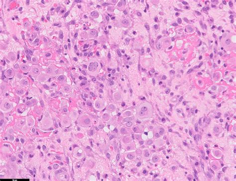Mesothelioma can be characterized as an uncommon type of malignancy that influences the mesothelium, the epithelioid: Pathology Outlines - Diffuse malignant mesothelioma