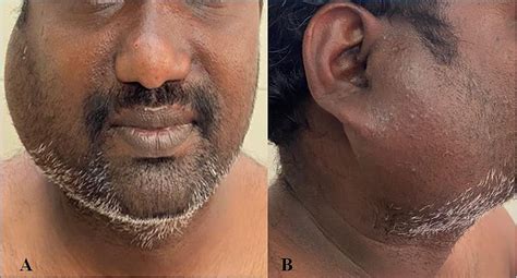 Cureus Kimura Disease Presenting As Right Parotid Swelling And Neck