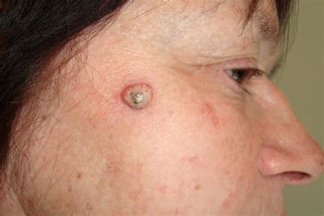 Squamous Cell Carcinoma Causes Symptoms And Treatment Options