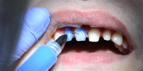 How Dental Veneers Are Installed On Teeth In Four Stages Veneers Dubai